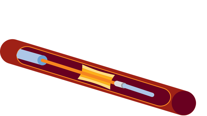 Pd Pa 血管