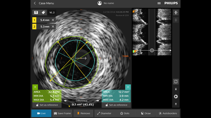 血管内超音波検査(IVUS)