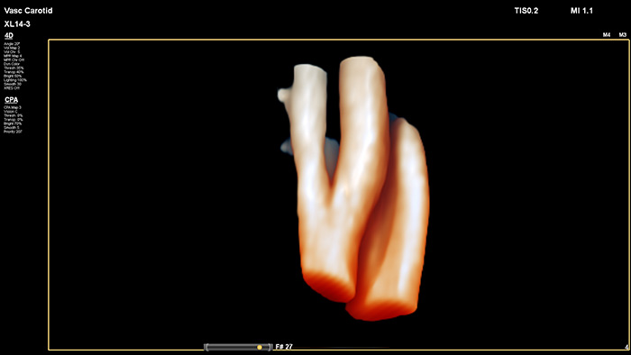 プラークの空間位置と組成を評価しやすく、3Dフローデータで狭窄や蛇行状態を評価できます image